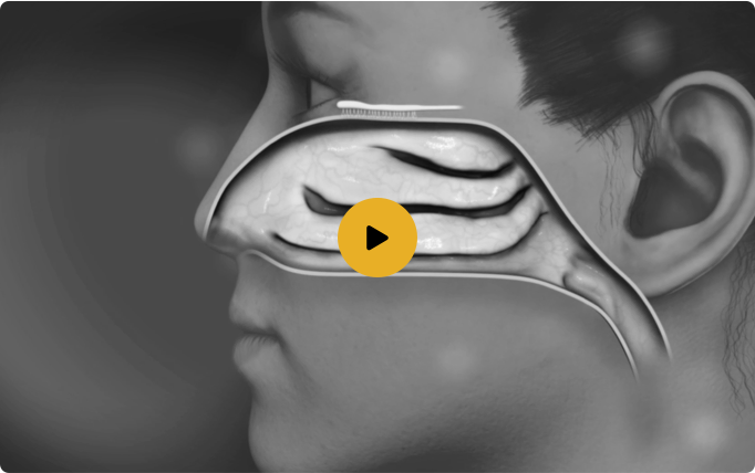 Watch video. Black and white still of a Trudhesa™ video with a person looking to the left with an illustration of the upper nasal space overlayed.